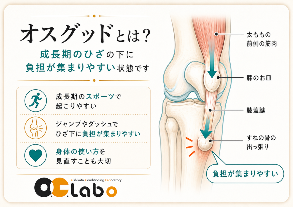 オスグッドで太ももの前側の筋肉から膝のお皿、膝蓋腱、すねの骨の出っ張りに負担が集まりやすい仕組みの図解