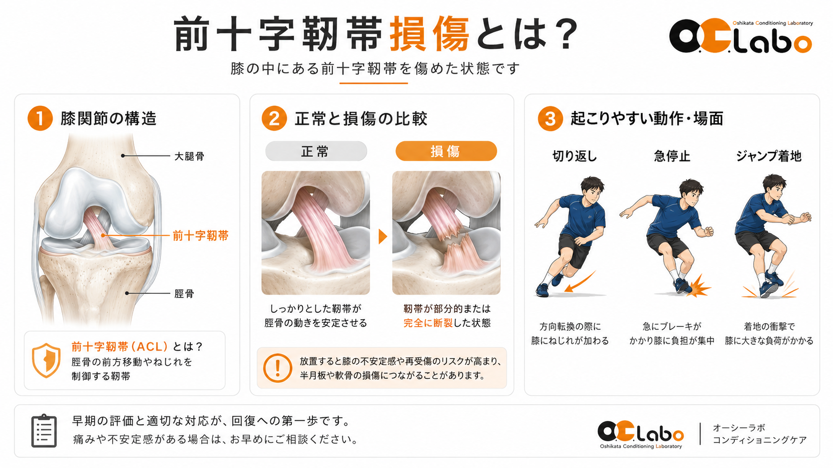 前十字靭帯（ACL）の位置、正常と損傷の比較、切り返し・急停止・ジャンプ着地を示す図