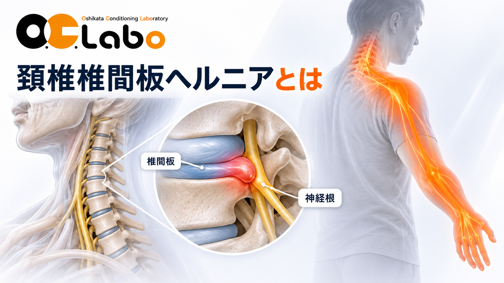頚椎椎間板ヘルニアとは