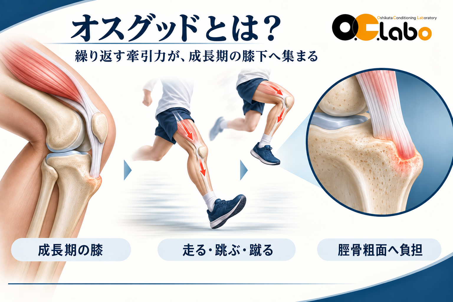 太ももの筋肉から膝蓋腱を介して脛骨粗面へ牽引力が加わるオスグッドの仕組み